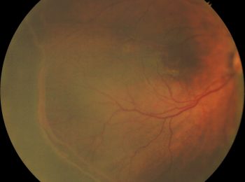 Retinopathy Of Prematurity