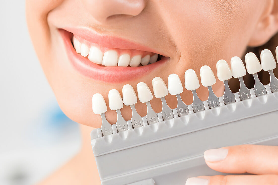 Tooth Whitening/Bleaching