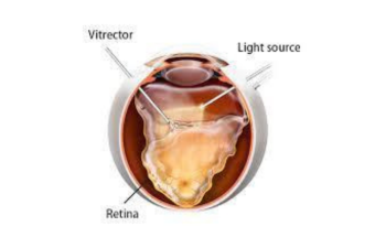 Advanced Vitreoretinal Surgeries
