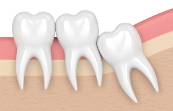 Third Molar Surgeries