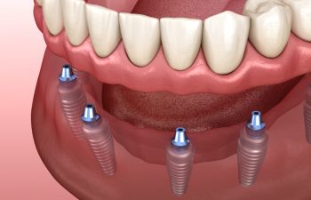 Implant & Implant Supported Dentures
