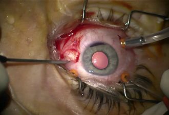 Retined intraocular foreign body (IOFB)