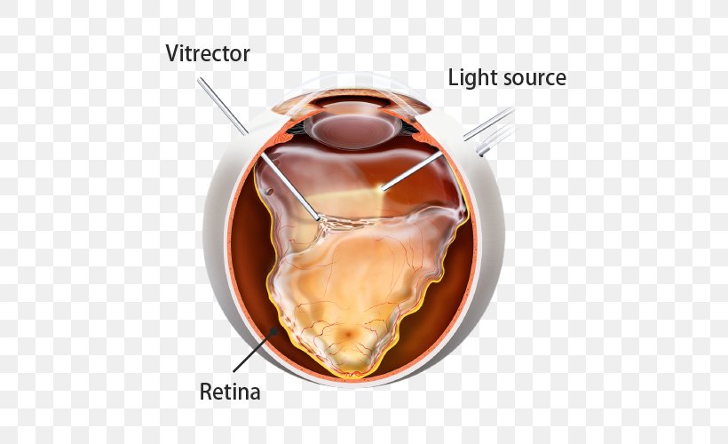 Retina Laser treatment in aurangabad-chintamani hospital