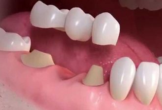 Crown-Bridges-Artificial-teeth